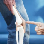 top 5 mistakes after knee replacement